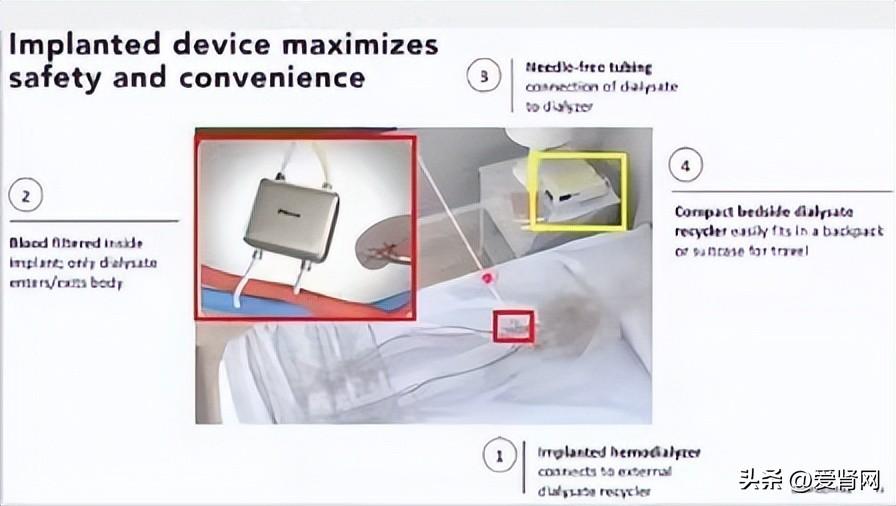 人工肾突破创新，引领肾病治疗新时代新消息