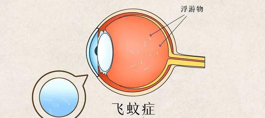 最新飞蚊症治疗方法和研究进展