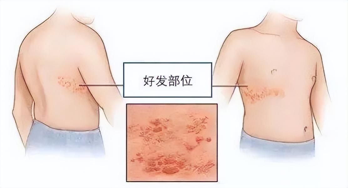 带状疱疹后遗神经痛最新治疗方法研究探讨